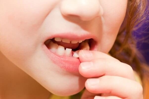 Một số giấc chiêm bao liên quan đến răng vỡ vụn khác